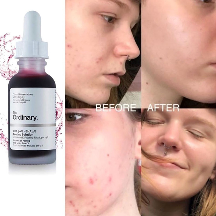 سرم پیلینگ اوردینری، لایه بردار قوی (30mL) The Ordinary, AHA 30% + BHA 2% Peeling Solution